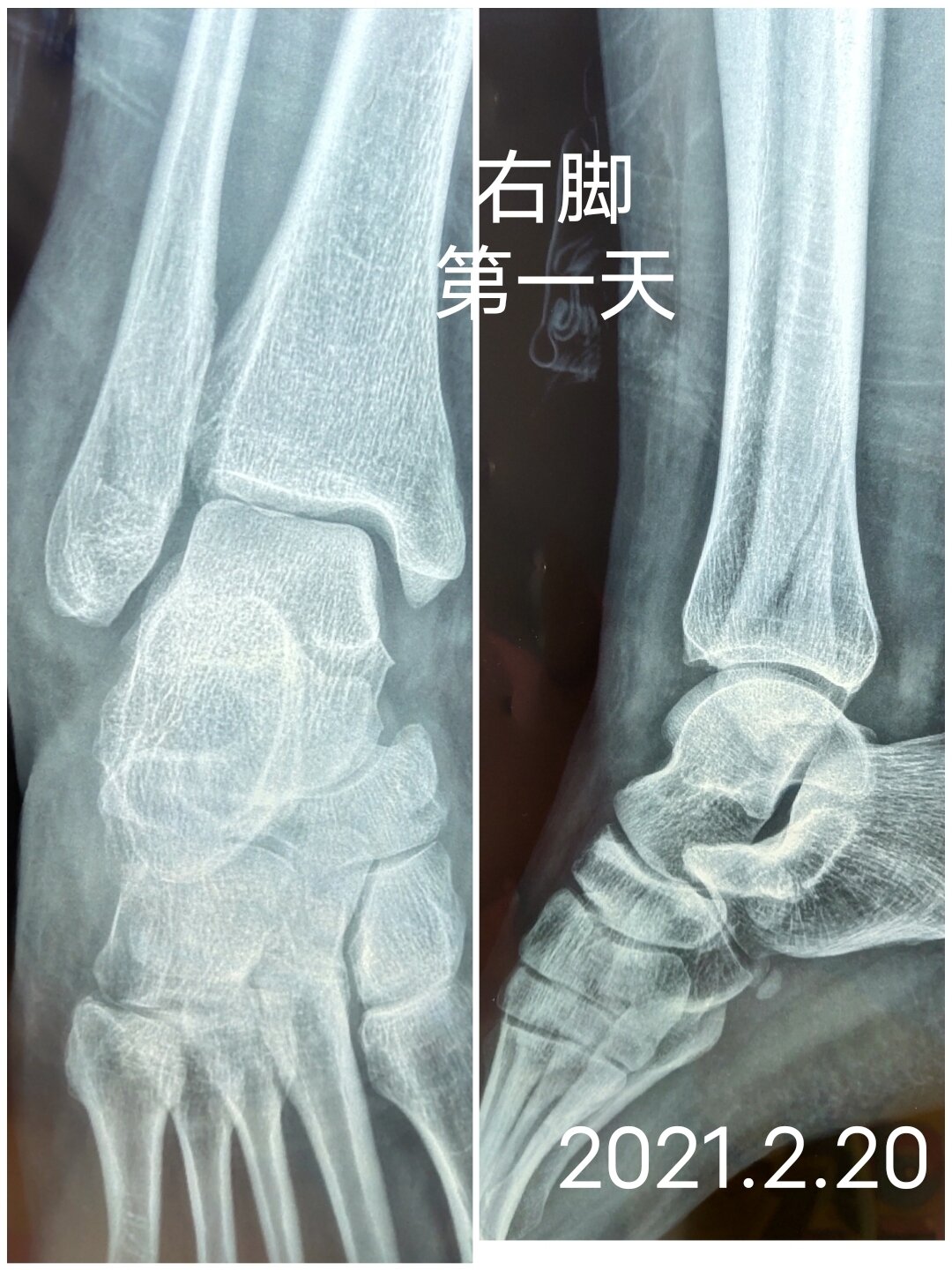 瓦尔兰右脚骨折需要缺席一段时间 瓦尔兰右脚骨折需要缺席一段时间